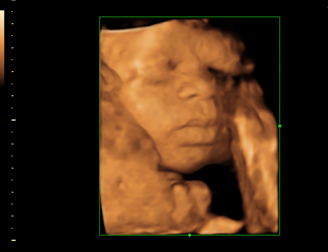 3D ultrasound image at 28 weeks